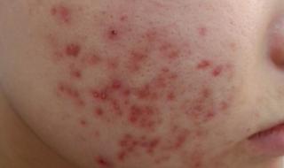 玫瑰痤疮最佳的治疗方法 痤疮怎样治
